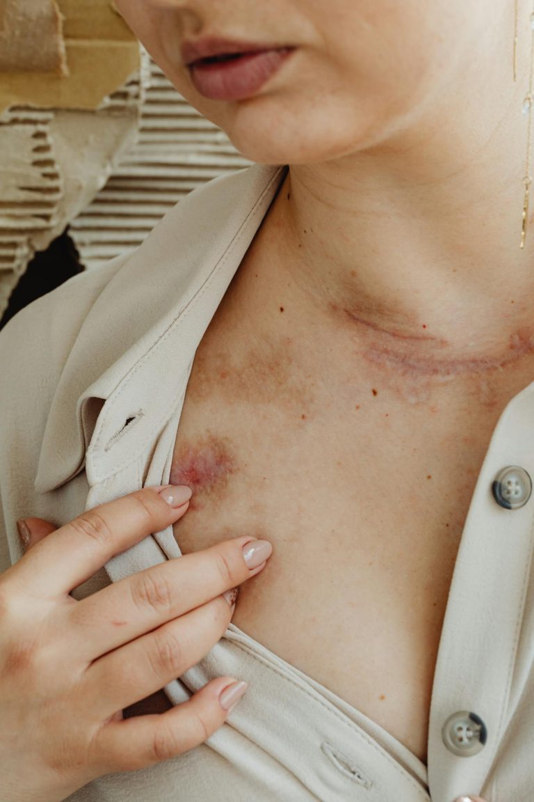 A detailed close-up of a woman's chest showing scars and bruises. Hand slightly touching the chest suggests pain or discomfort.