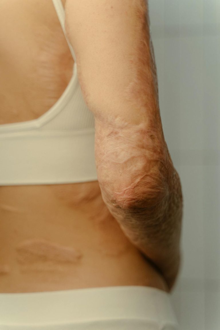 Detailed close-up of an arm showing burn scars, highlighting skin texture and healing process.