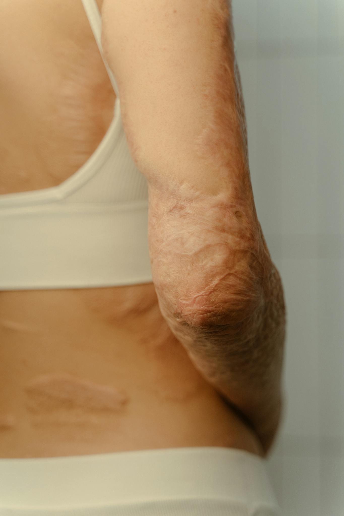Detailed close-up of an arm showing burn scars, highlighting skin texture and healing process.